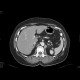 Vena cava sinistra, continuation of hemiazygous vein: CT - Computed tomography